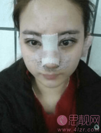 上海鼻部综合手术恢复半年