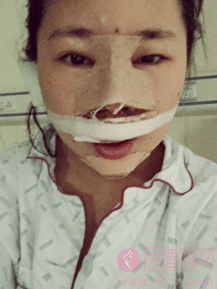 北京的硅胶鼻部手术隆鼻加垫下巴术后