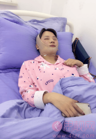 北京做面部吸脂后手术案例