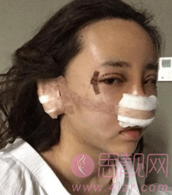 杭州眼部手术加硅胶隆鼻恢复案例