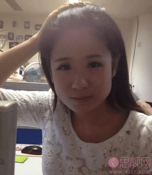 上海小方脸下颌角磨骨手术恢复案例
