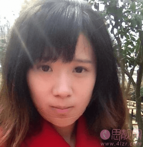 上海小方脸下颌角磨骨恢复案例