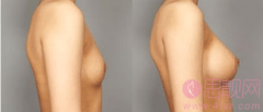 乳房松弛下垂可以用假体隆胸改良？