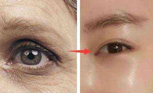 眼角注射玻尿酸去皱副作用？