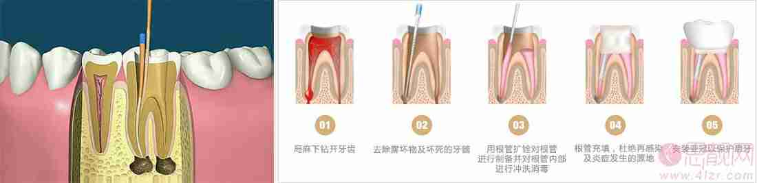 根管调节后，牙齿到底还能用多久？