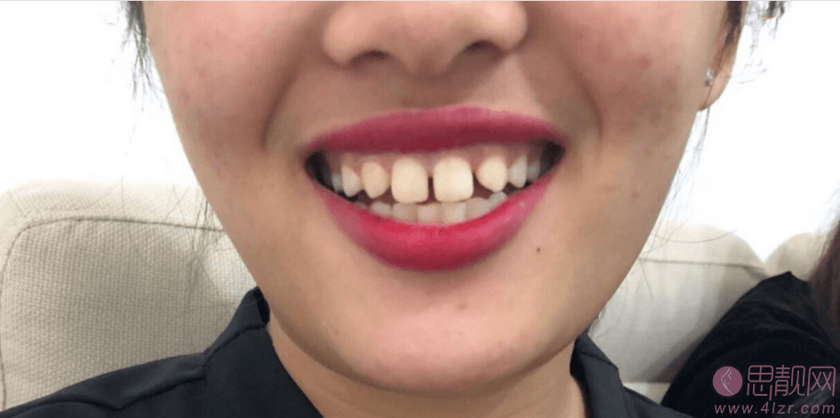 福州三颗牙口腔医院看牙怎么样？附牙齿美白案例及2021年价格表发布