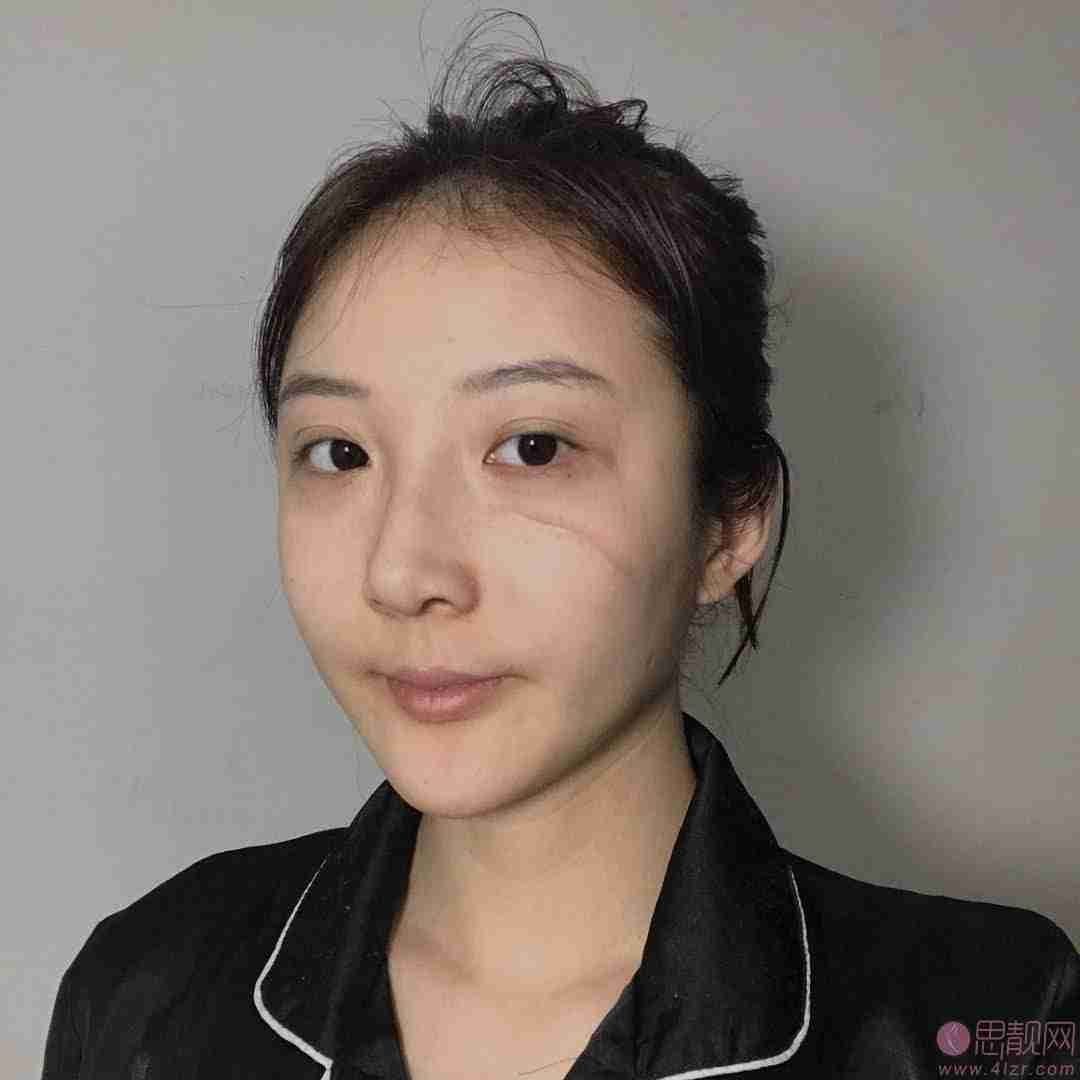 西京医院烧伤整形科祛疤怎么样？附祛疤真人案例及2021年价格表公布
