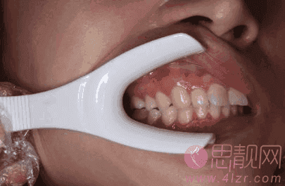 上海摩尔口腔牙齿矫正案例,术后真人果展示