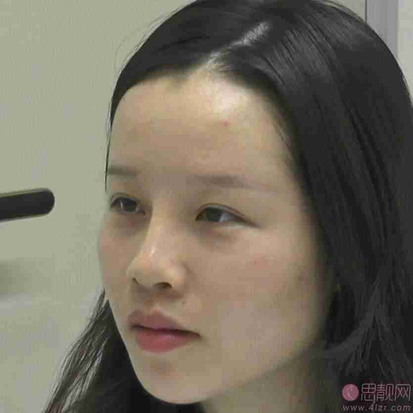 北京大麦微针植发医院怎么样？附眉毛种植案例及2021价格表公开