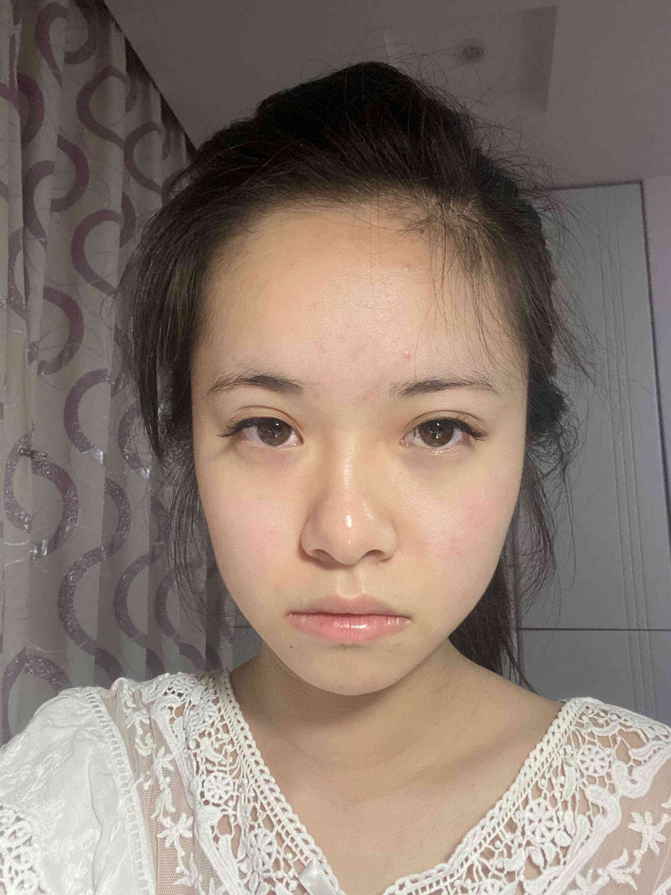 重庆当代整形美容医院双眼皮做得怎样？附双眼皮案例