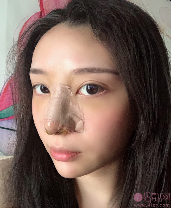 重庆华美整形美容医院2021价格表曝光+鼻修复手术案例分享