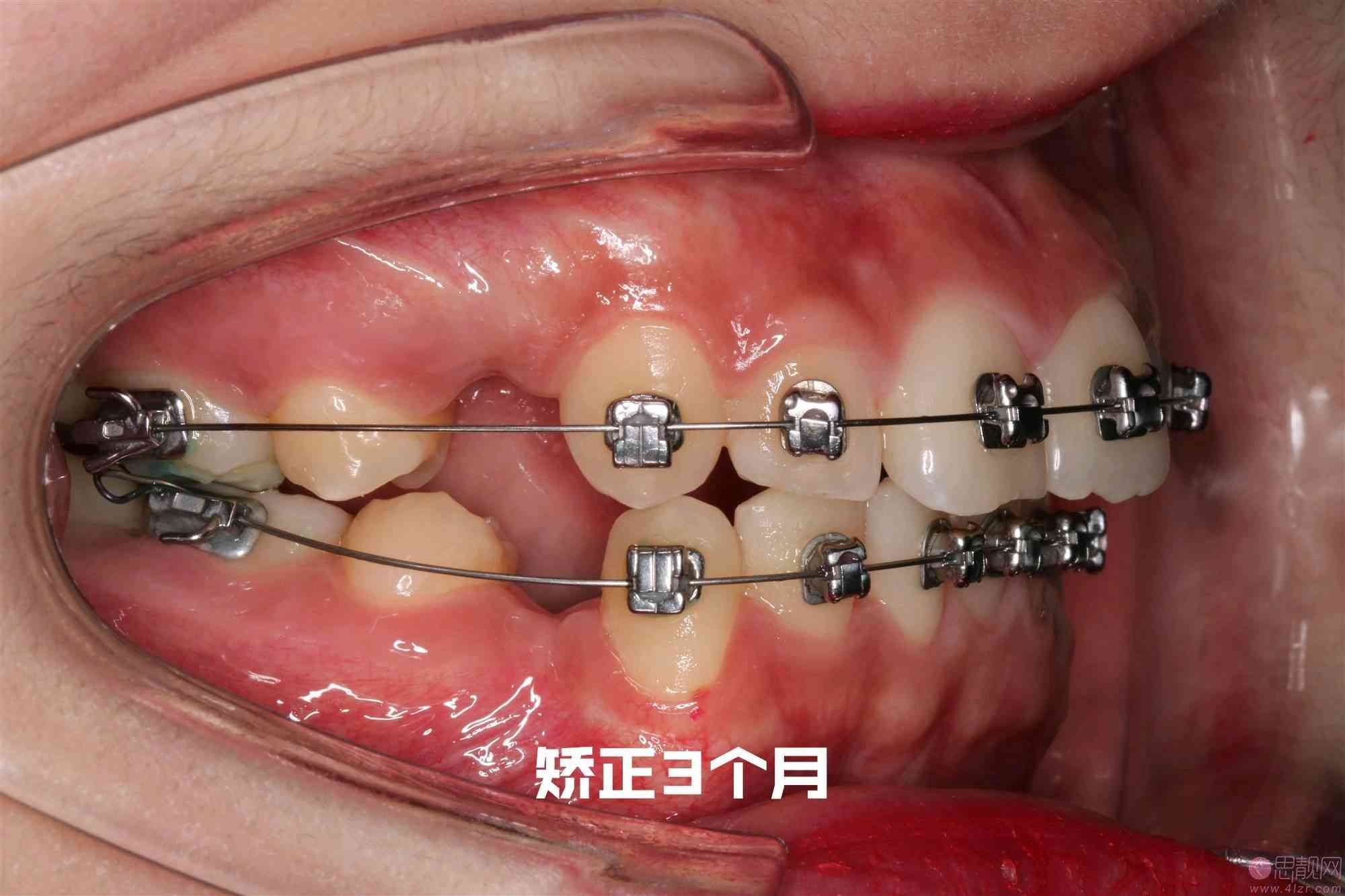 广州广大口腔门诊部怎么样？牙齿矫正案例分享、2021价格表一览