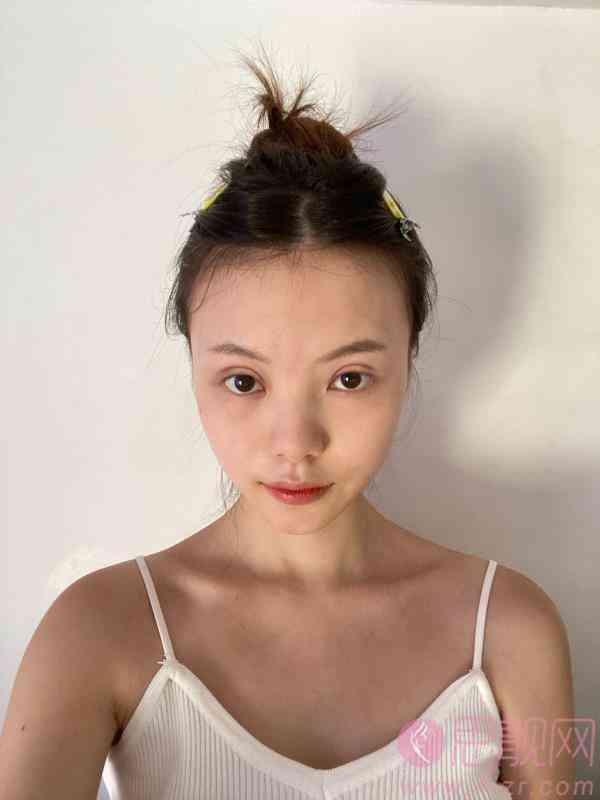武汉乐享医疗美容杨蓉双眼皮案例分享及恢复过程一览