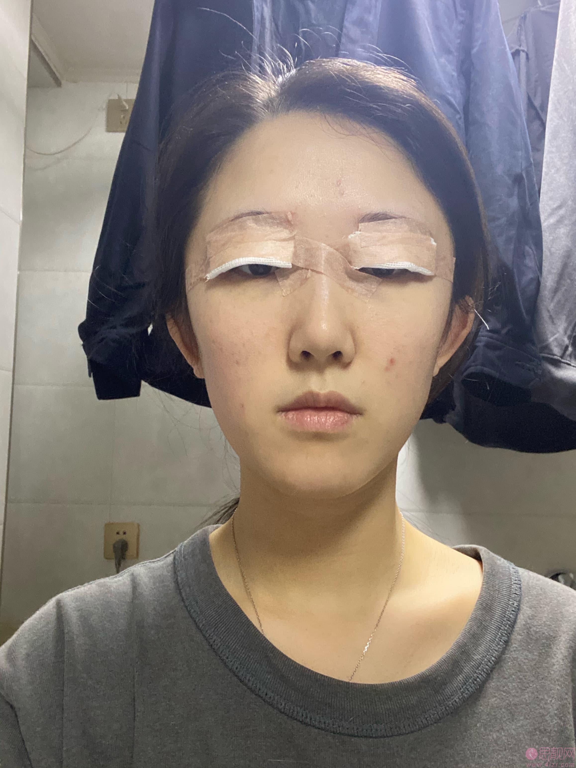 北京协和医院黄渭清做双眼皮怎么样？