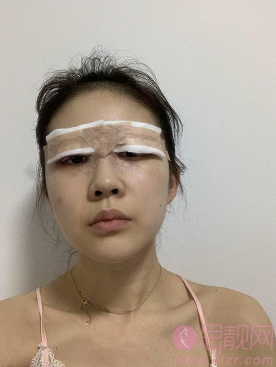 北京协和医院黄久佐做双眼皮怎么样？