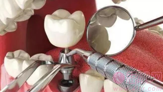 北京种植牙价格一般在多少？牙齿种植的过程及注意事项分享！