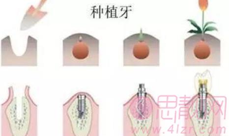 北京种植牙价格一般在多少？牙齿种植的过程及注意事项分享！