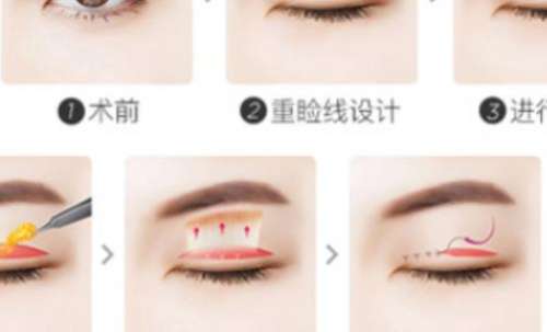 韩式双眼皮的手术方法有哪几种，有必要吗?